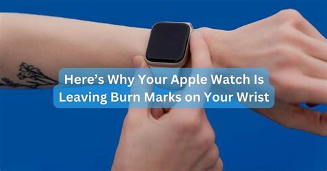 watch marks on wrist|apple watch burn mark on wrist.